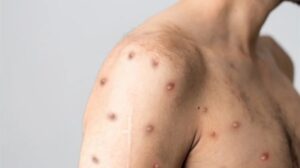 Monkeypox alias Cacar Monyet, Menular ke Manusia dan Bisa Sembuh Sendiri